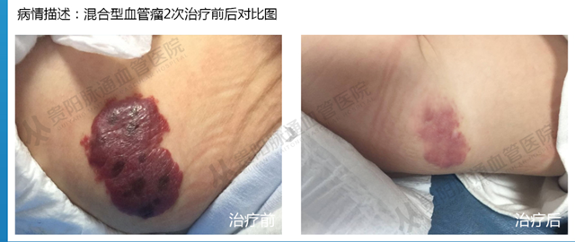 【贵阳血管瘤治疗案例】智能腔内综合治疗前后对比20.png