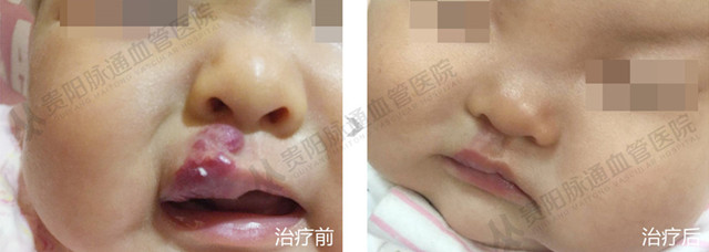 【贵阳血管瘤治疗案例】智能腔内综合治疗前后对比 14.jpg